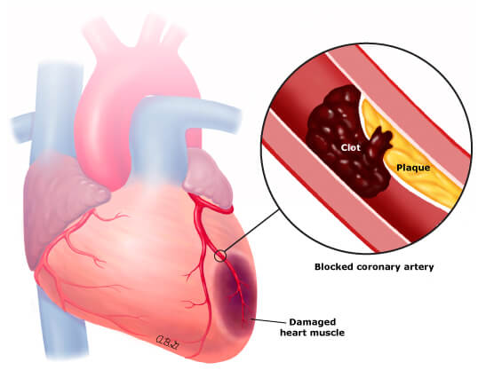 Diagram of an artery and heart muscle during a widowmaker heart attack.